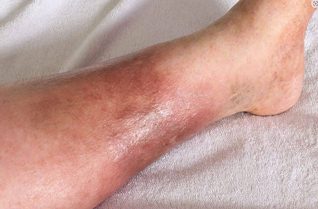 봉와직염 초기증상 및 원인, 치료, 치료기간, 병원 진료과 : 연조직염, 봉소염 1 다리에 봉와직염이 걸린 사람 : 봉와직염 증상 사진