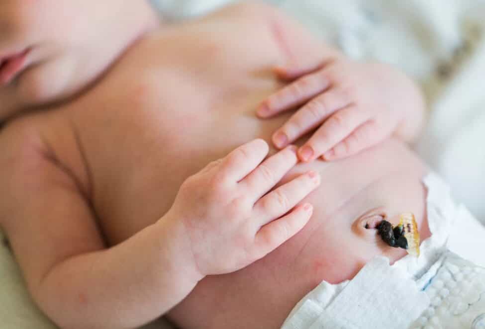 배꼽 염증이 생긴 아기
